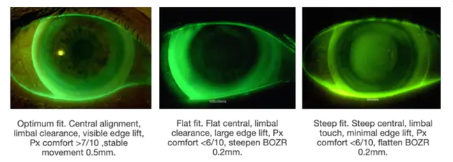 Corneal Reflex : 角膜反射