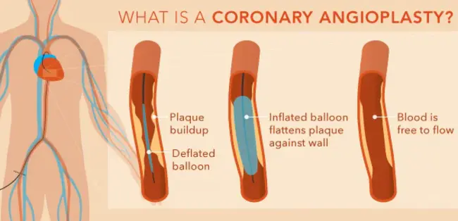 Coronary Angioplasty & Rotablator Atherectomy Trial : 冠状动脉成形术与旋转消融器动脉切除术试验