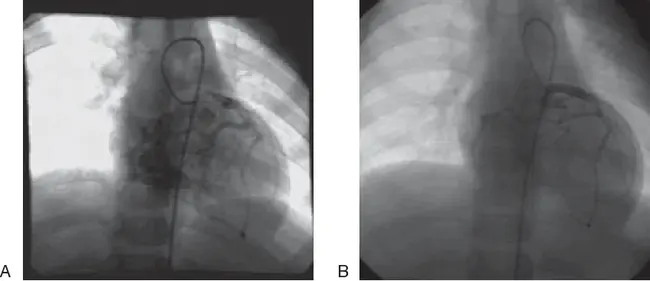 Coronary Artery Fistula : 冠状动脉瘘