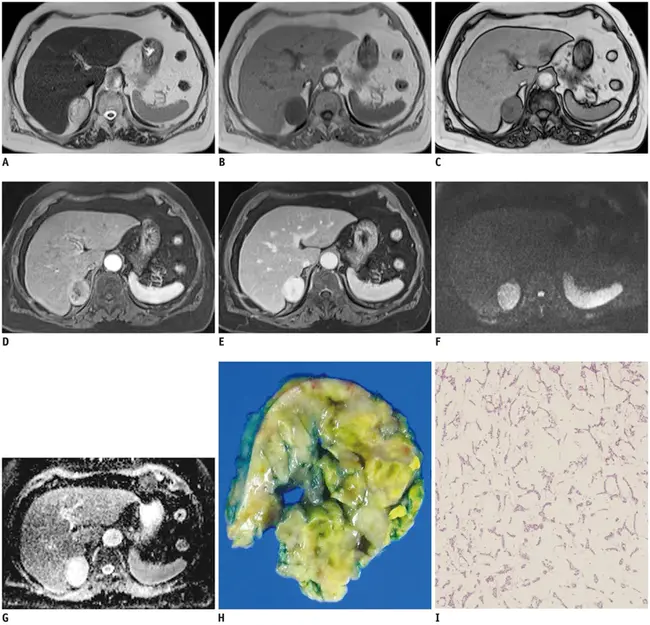 Cortical Amygdaloid Nucleus : 杏仁核皮质