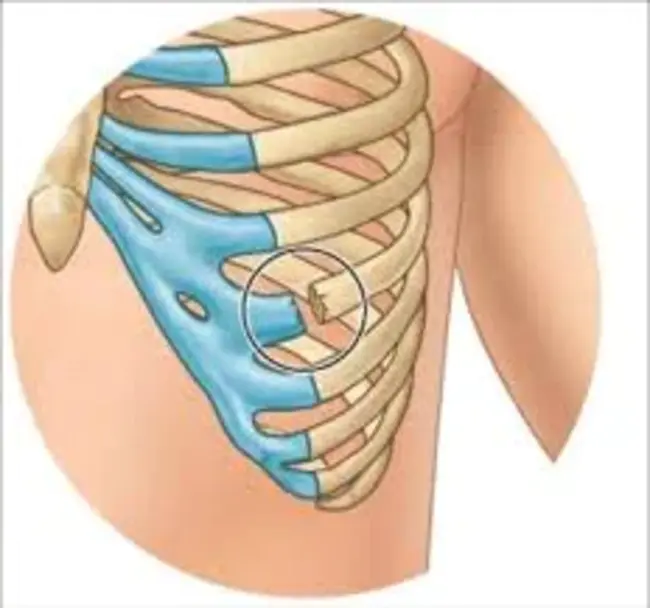 costochondral graft : 肋软骨移植