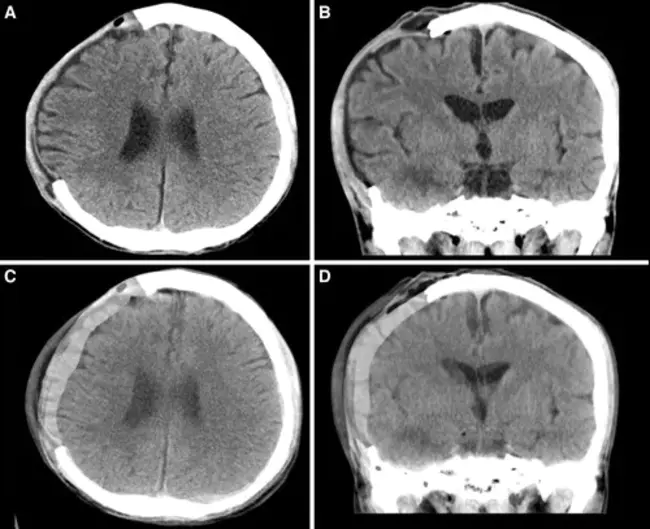 cranial CT–cranial computed tomography : 颅脑 CT-颅脑计算机断层扫描