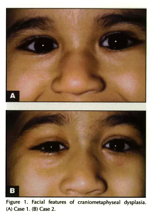 craniometaphyseal dysplasia : 颅缝发育不良