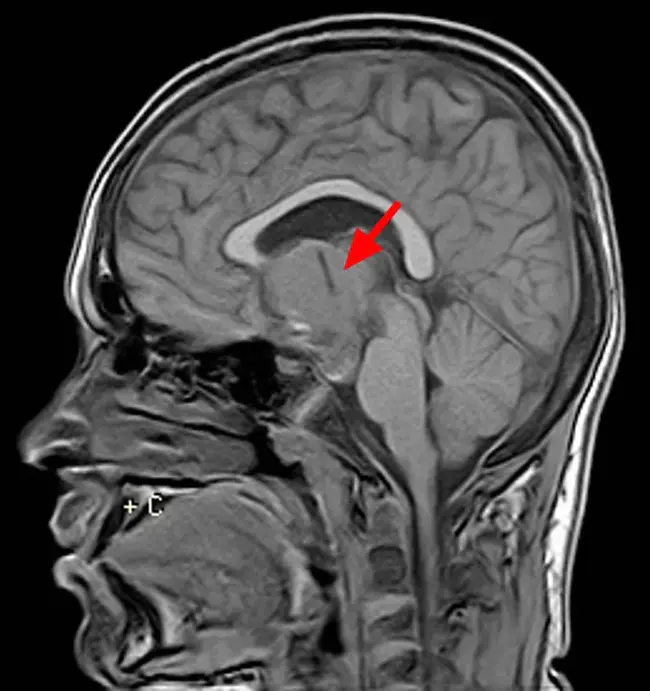 craniopharyngioma : 颅咽管瘤