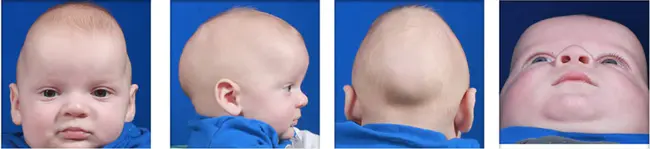 craniosynostosis : 颅缝匠病