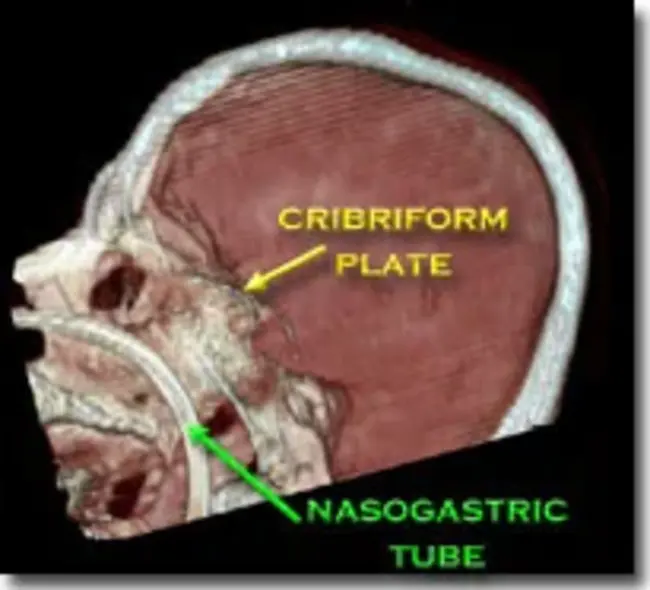 Cribriform Plate : 筛板