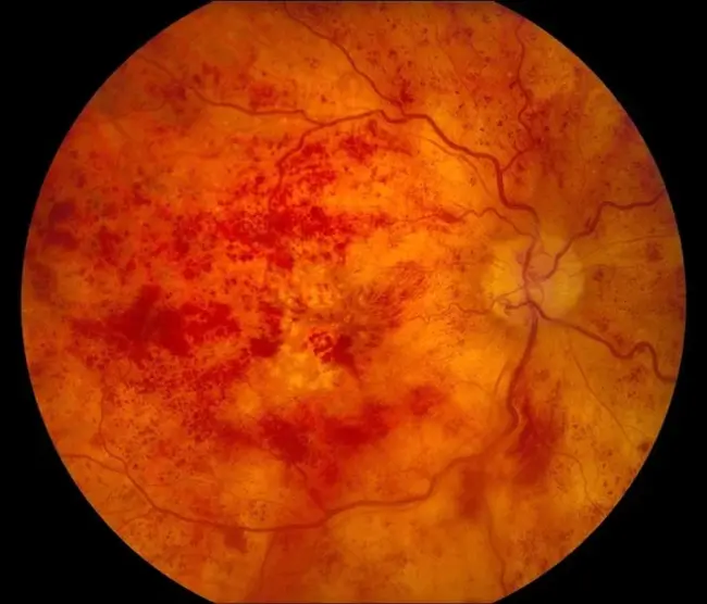 Cystoid Macular Edema : 黄斑囊样水肿