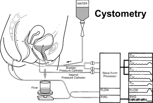 CystoMetroGraphy : 膀胱造影术