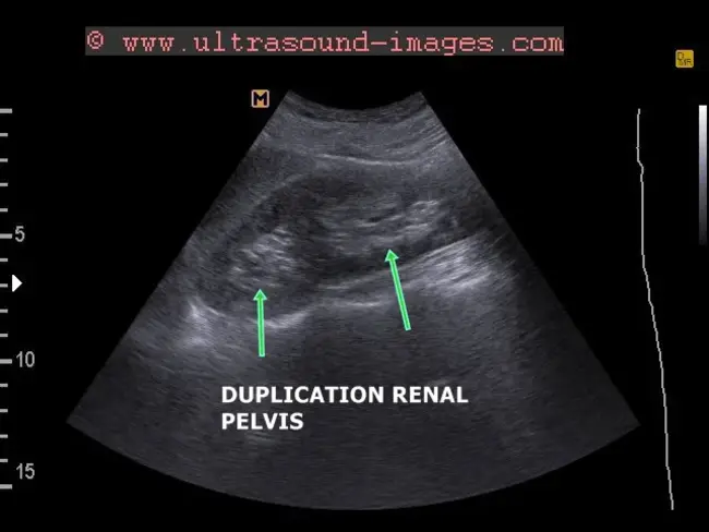 Cytogenetic Complete Remission : 细胞遗传学完全缓解