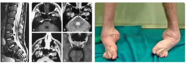 Dejerine-Sottas Neuropathy : 德杰琳-索塔斯神经病