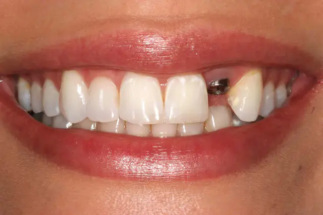 Dental Papillae : 牙乳头