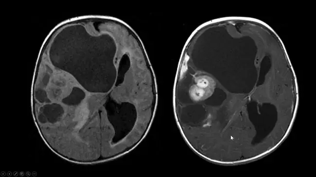 Desmoplastic Infantile Ganglioglioma : 软骨增生性婴儿神经节胶质瘤