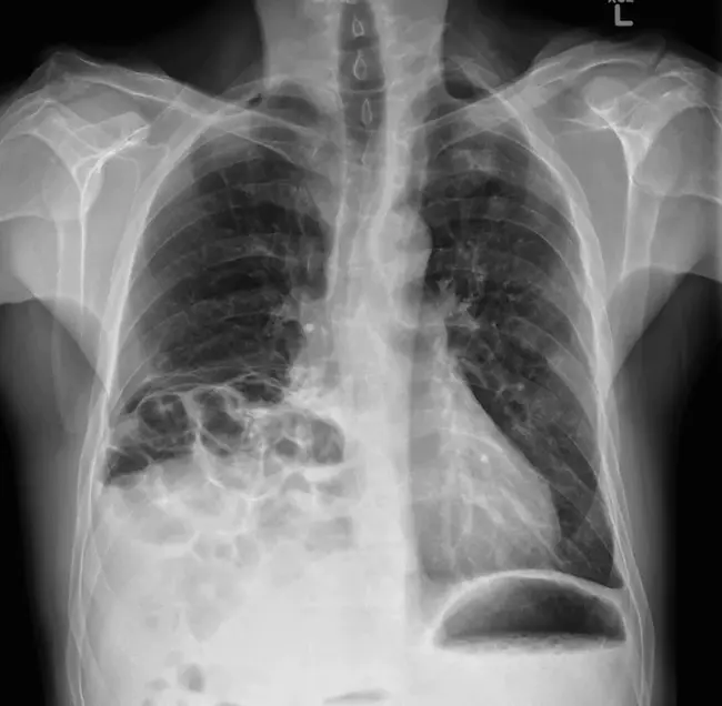 Diaphragmatic Hernia : 膈疝