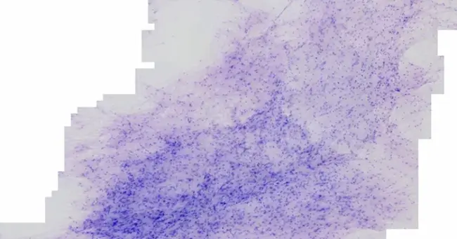 Diffusely Infiltrating Astrocytoma : 弥漫性浸润性星形细胞瘤