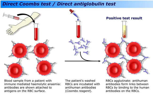 direct Coombs test : 直接库姆斯试验