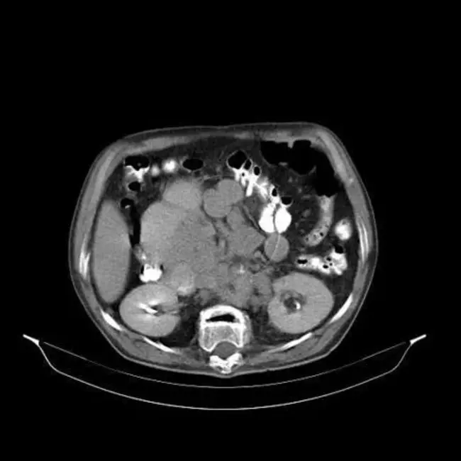 Distal Rectal Adenocarcinoma : 直肠远端腺癌