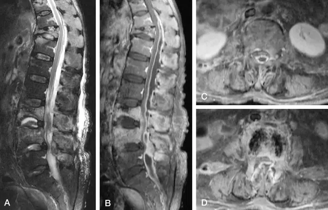 Dorsal Dural Deficiency : 背侧硬脑膜缺损