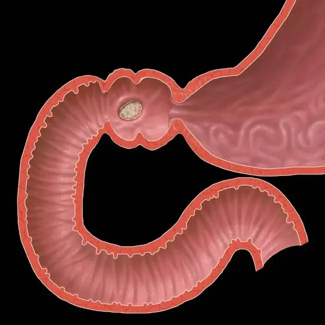 Duodenal Pressure : 十二指肠压力