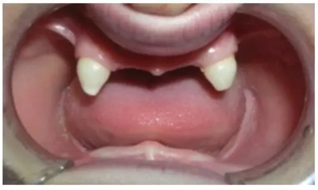 ectodermal dysplasia with ectrodactyly and cleft lip or palate : 外胚层发育不良伴外翻畸形和唇腭裂