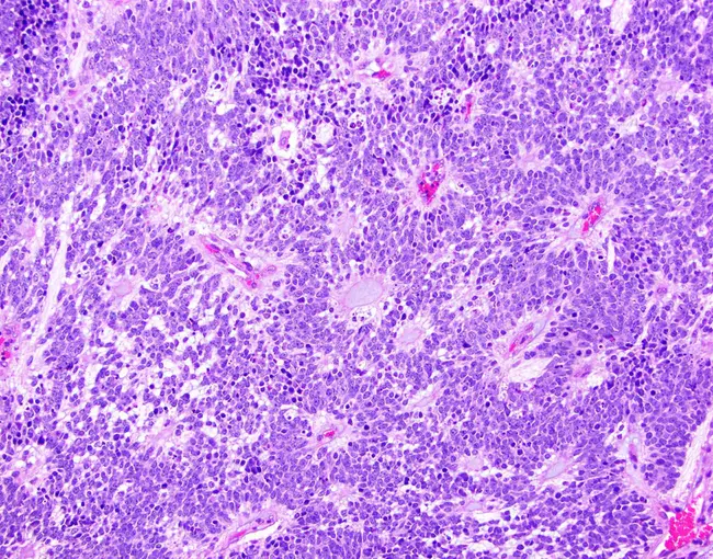 Embryonal Carcinoma : 胚胎癌