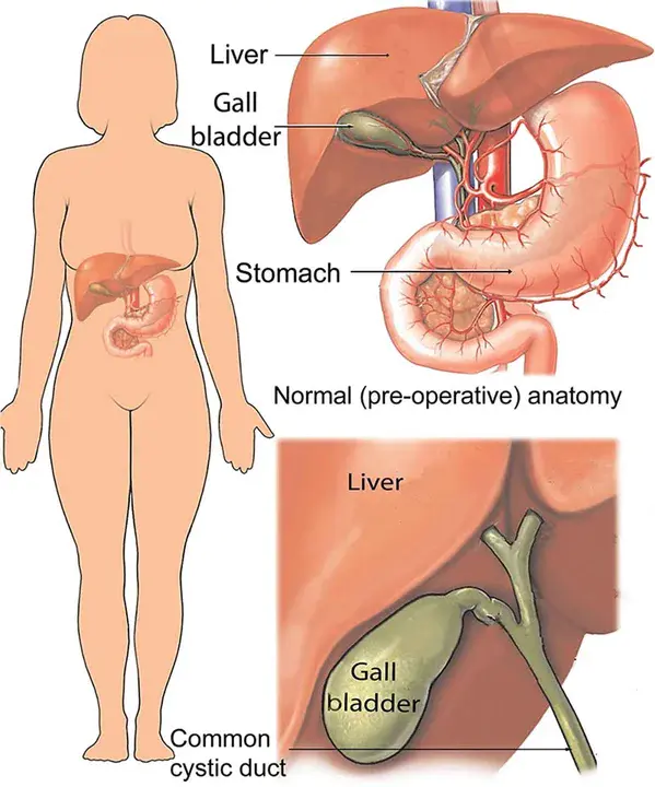 Emphysematous Cholecystitis : 气肿性胆囊炎