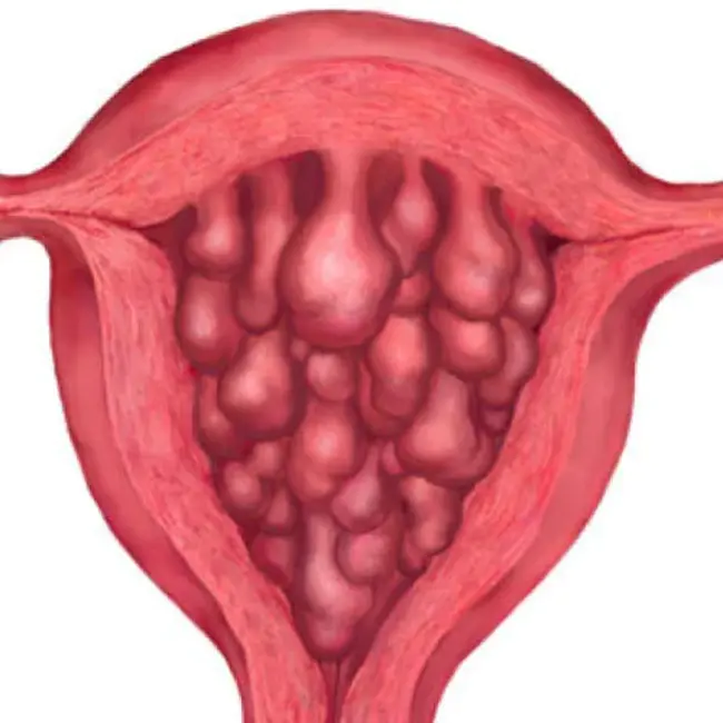 endocervical : 宫颈内的