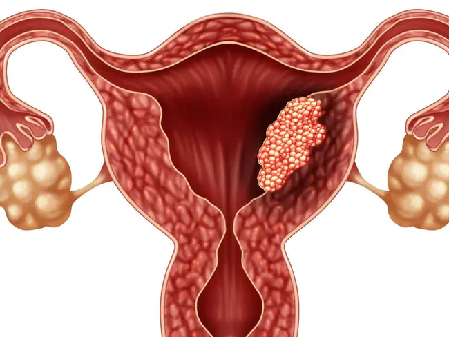 Endometrial Cancer : 子宫内膜癌