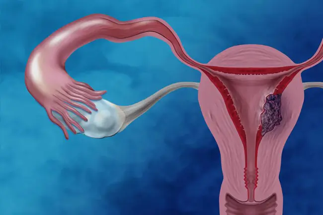 Endometrial Stromal : 子宫内膜间质