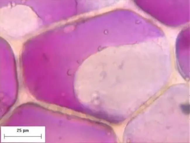 Epidermal Hyperplasia : 表皮增生