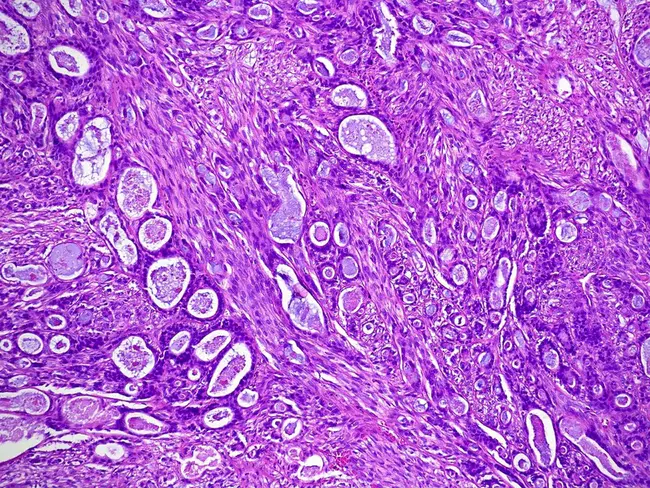 Epithelial-Myoepithelial Carcinoma : 上皮肌上皮癌