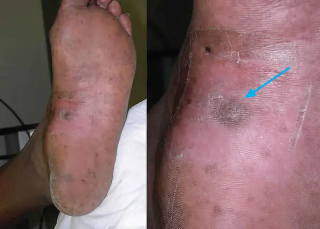 Epithelioid Hemangioendothelioma : 上皮样血管内皮瘤