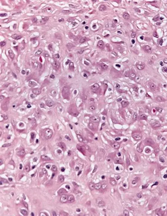 Epithelioid Sarcoma : 上皮样肉瘤