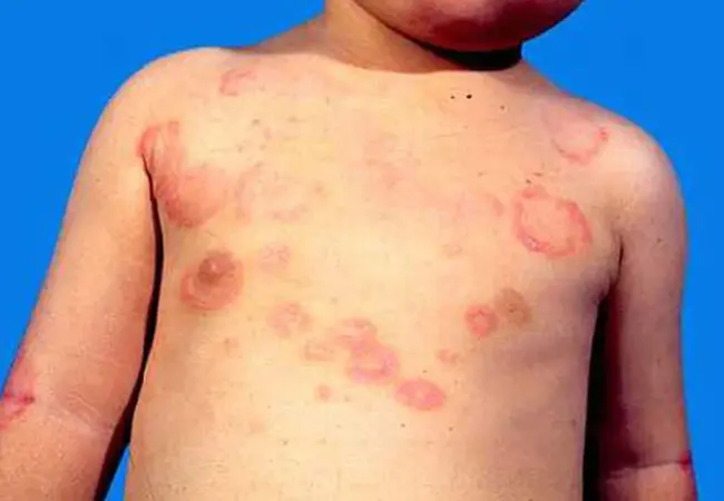 Erythema Chronicum Migrans : 慢性偏头痛红斑