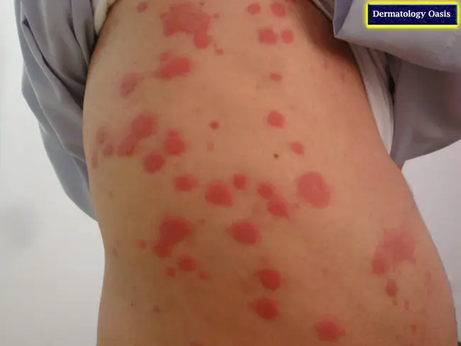 Erythema Induratum : 硬化性红斑