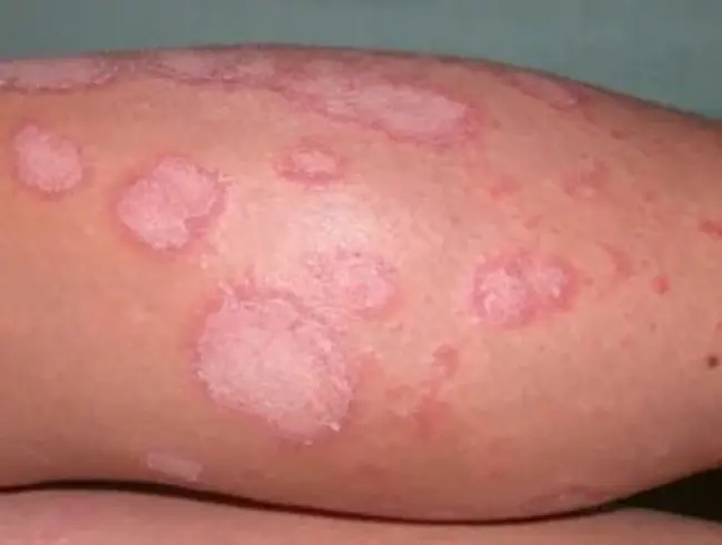 Erythema Infectiosum : 感染性红斑