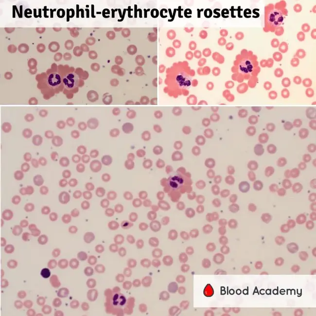 Erythrocyte Rosette : 红细胞玫瑰花结