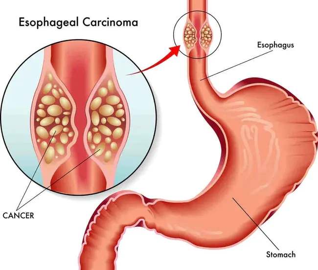 Esophageal Intramural Pseudodiverticulosis : 食管壁内假憩室病