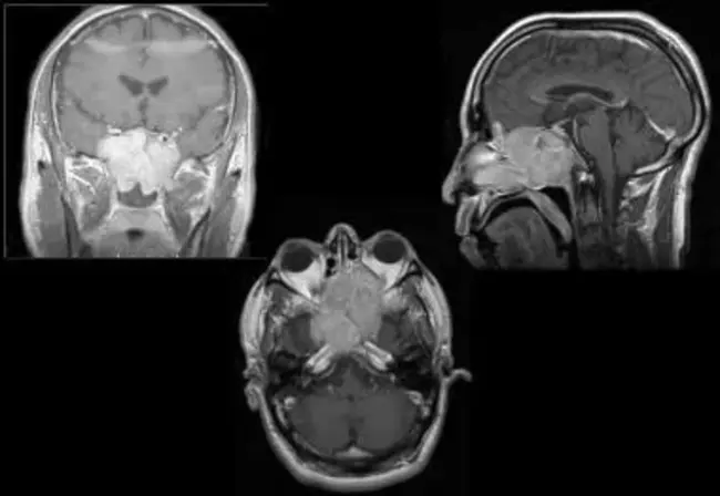 esthesioneuroblastoma : 感觉神经母细胞瘤