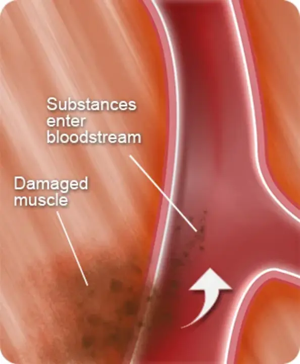 Exertional Rhabdomyolysis : 运动性横纹肌溶解症