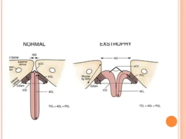 Exstrophy-Epispadias Complex : 外翻-尿道上裂复合体