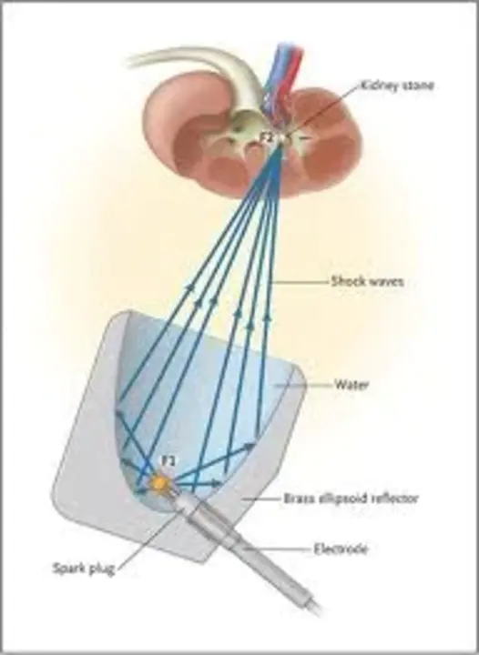 extracorporeal photopheresis : 体外光合