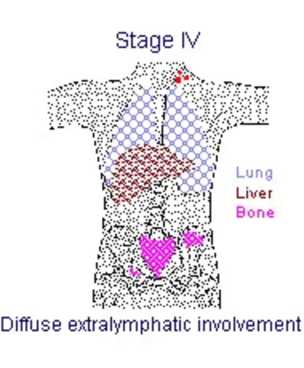 Extralymphatic : 溶胞外的