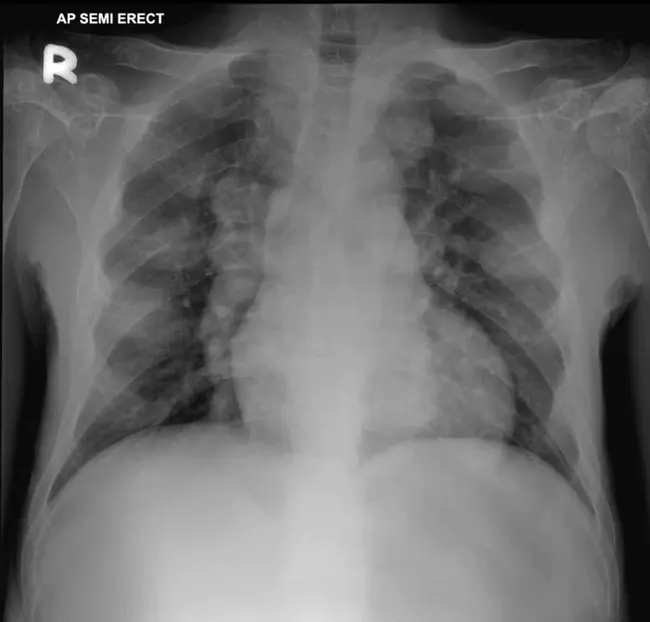 Extramedullary Haematopoiesis : 髓外造血