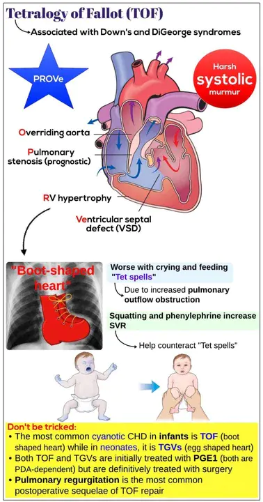 Fallot’s tetralogy : 法洛四联症