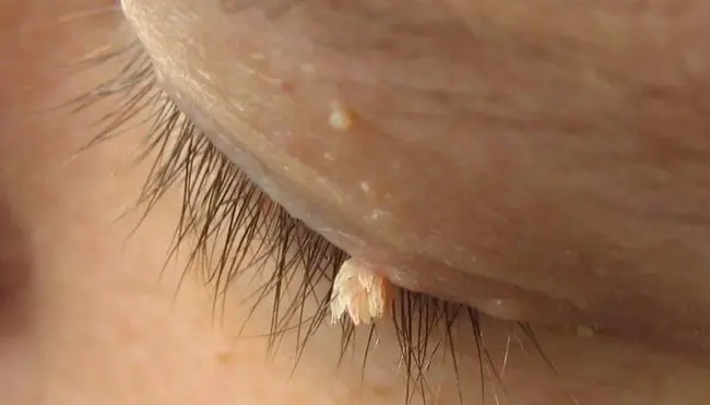 filiform papillae : 丝状乳头