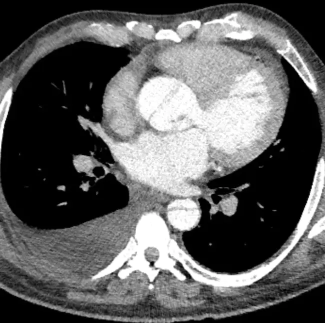 Focal Intestinal Perforation : 局灶性肠穿孔