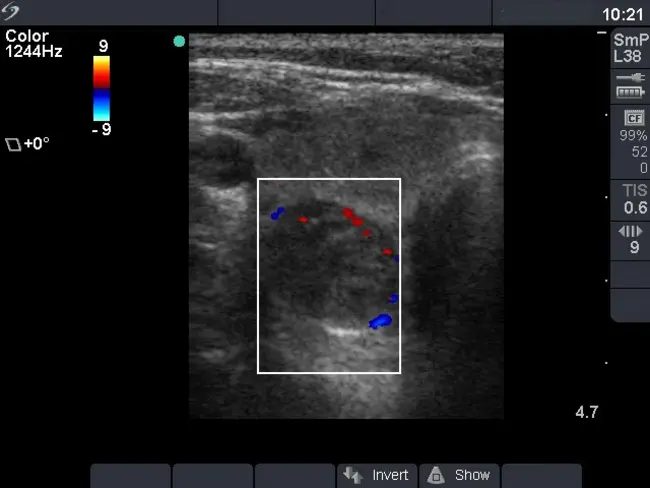 Follicular Lesion of Undetermined Significance : 意义不明的毛囊病变