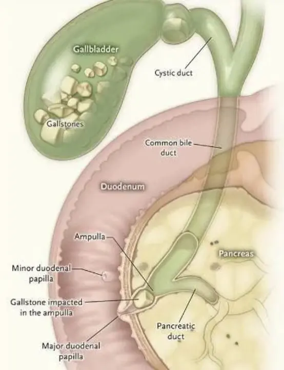 Gallstone Pancreatitis : 胆石性胰腺炎