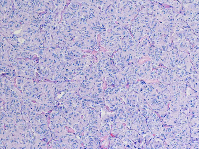 Gangliocytic Paraganglioma : 神经节细胞副神经节瘤