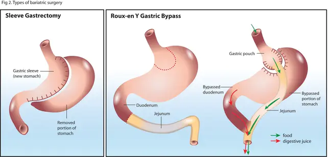 Gastric Cardia Cancer : 贲门胃癌